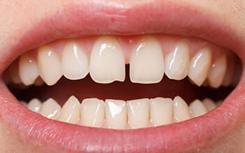 Smile teeth