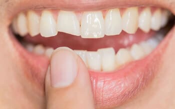 Smile teeth