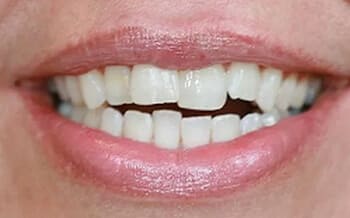 Smile teeth