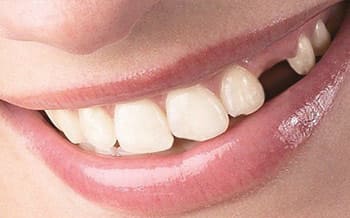 Smile teeth