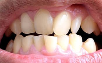 Smile teeth