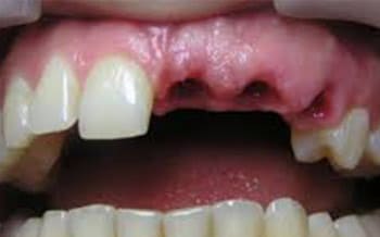 Smile teeth