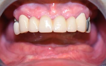 Smile teeth