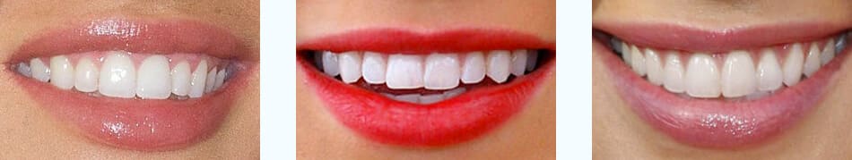 Smile implant